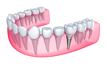 illustration of gum line with real teeth next to dental implants Shelby Township, MI